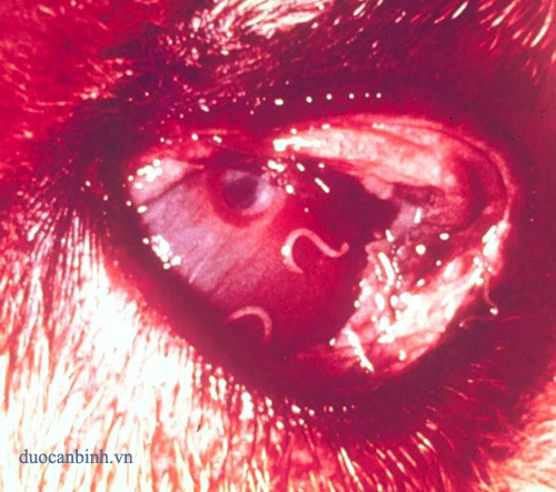 Một bệnh nhân bị 5 con giun chó chui vào mắt